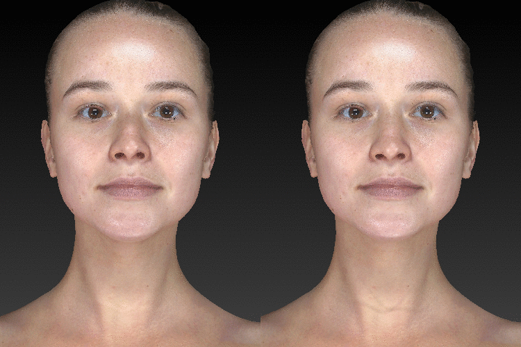 Vectra 3D Imaging of woman's chin