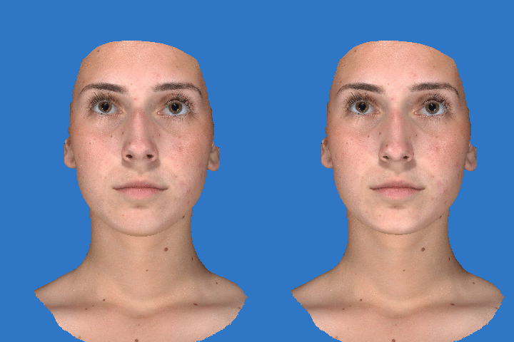 Vectra 3D Imaging of woman's nose