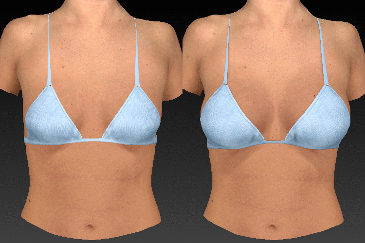 Vectra 3D Imaging system of woman's breasts