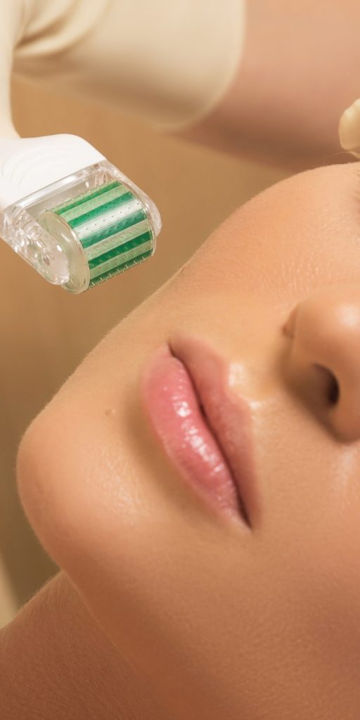 A close-up of a woman's face as she undergoes a RF microneedling treatment.