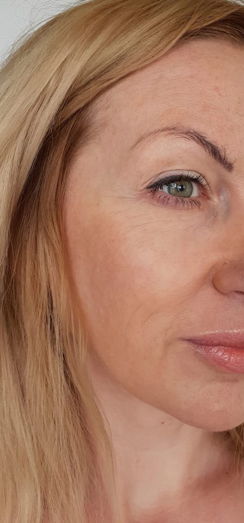 The profile of a woman's face before a Restylane filler treatment.
