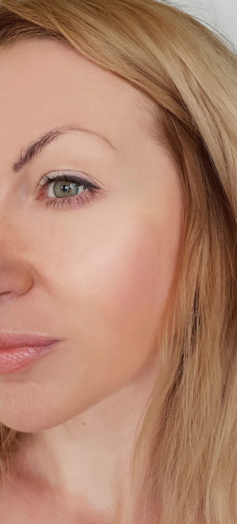 The profile of a woman's face after a Restylane filler treatment.