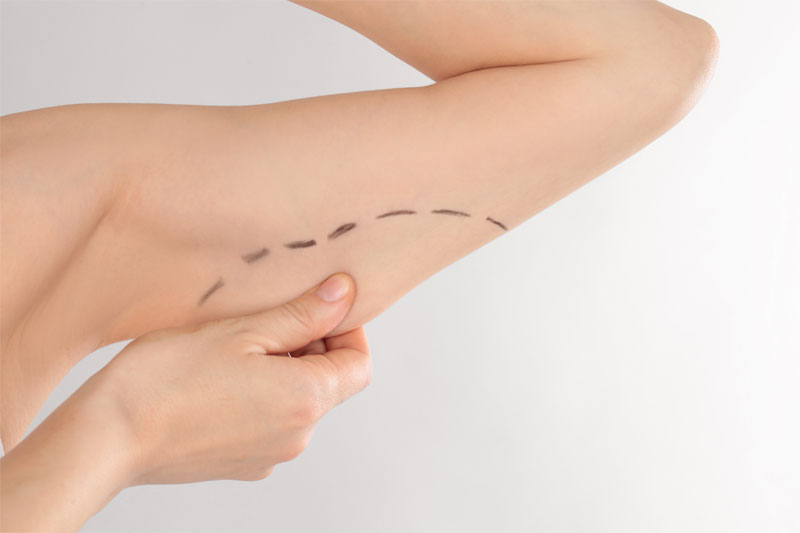 An arm with dotted lines drawn around saggy skin.